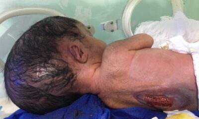 Newborn baby with birth defects in Al-Fallujah