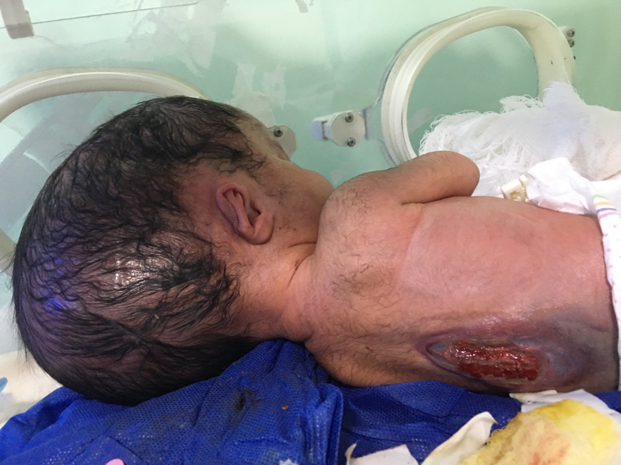 Newborn baby with birth defects in Al-Fallujah